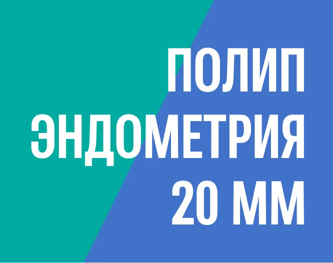 Удаление полипа эндометрия 20 мм путём офисной гистероскопии