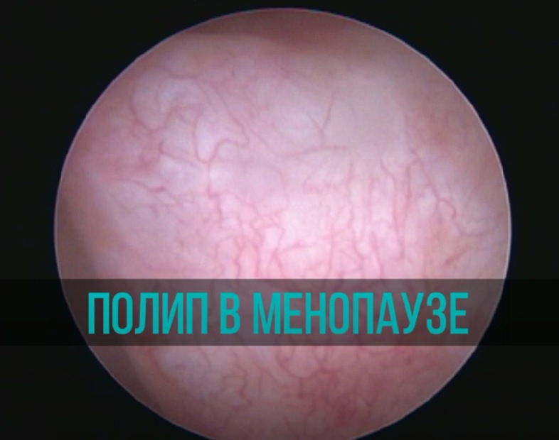 Полип эндометрия и стеноз цервикального канала в менопаузе