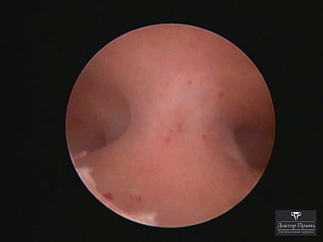 Гистероскопическое изображение: контрольный осмотр полости матки, состояние слизистой