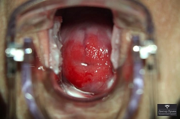 Осмотр шейки матки в зеркалах при эрозии (пример 2)