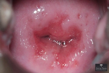 Кольпоскопия: эрозия шейки матки вокруг наружного зева (пример 1)