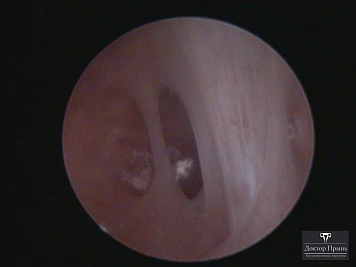 Гистероскопическое изображение: участок полости матки с выраженной складкой/перемычкой