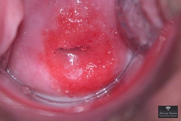 Кольпоскопия: эрозия шейки матки, неровная зона покраснения (пример 8)