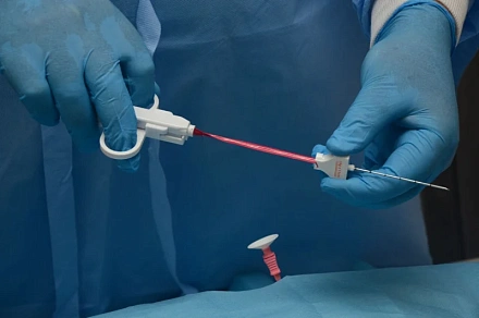 Биопсия шейки матки