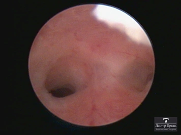 Гистероскопическое изображение: спаечные тяжи (синехии) с просветом, обзор области
