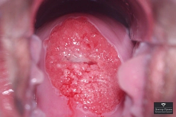 Обширные изменения эпителия шейки матки при эрозии (пример 7)