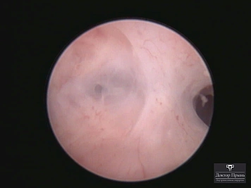 Гистероскопическое изображение: обзор полости матки, визуализация устья маточной трубы