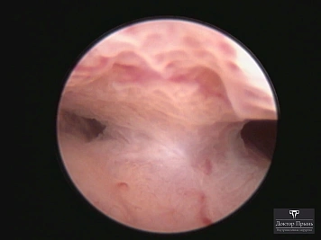 Гистероскопическое изображение: внутриматочные синехии, паутиноподобные спайки в полости