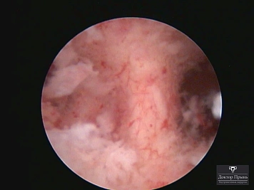 Гистероскопическое изображение: зона спаек, вид на ткани и рабочую область инструмента