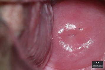 Шейка матки крупным планом при осмотре в зеркалах (вид наружного зева)
