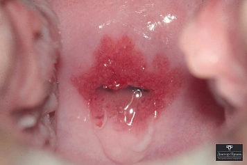 Осмотр шейки матки: умеренное покраснение в зоне наружного зева (пример 9)