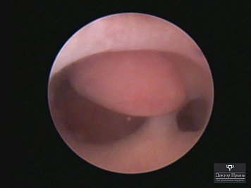 Гистероскопическое изображение: перемычка в полости матки, обзор полости