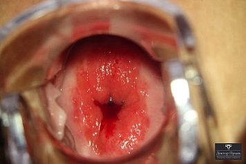 Кольпоскопия: эрозивные изменения шейки матки, выраженное покраснение (пример 3)