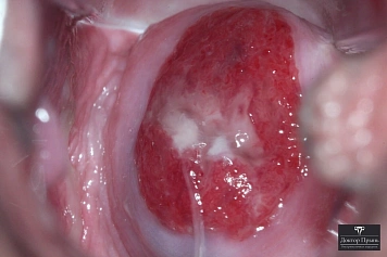 Шейка матки после обработки эрозии: зона воздействия (пример 6)