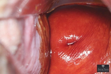 Осмотр шейки матки крупным планом после обработки слизистой (контрольный снимок)