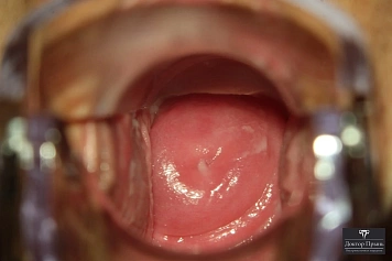 Осмотр шейки матки в гинекологических зеркалах — общий вид