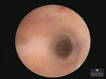 Гистероскопическое изображение: прохождение цервикального канала (вид через гистероскоп)