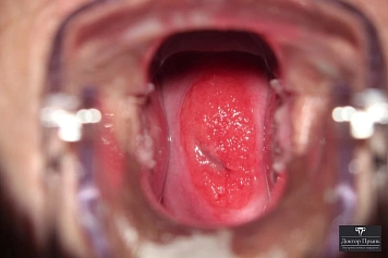 Осмотр шейки матки: обширная зона эрозии (пример 4)