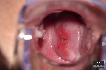 Кольпоскопия: локальная эрозия шейки матки (пример 5)