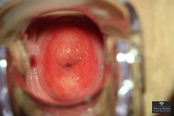 Кольпоскопия: эрозия шейки матки в области наружного зева (пример 10)