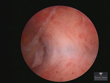 Гистероскопическое изображение: внутриматочные спайки (синехии), крупный план